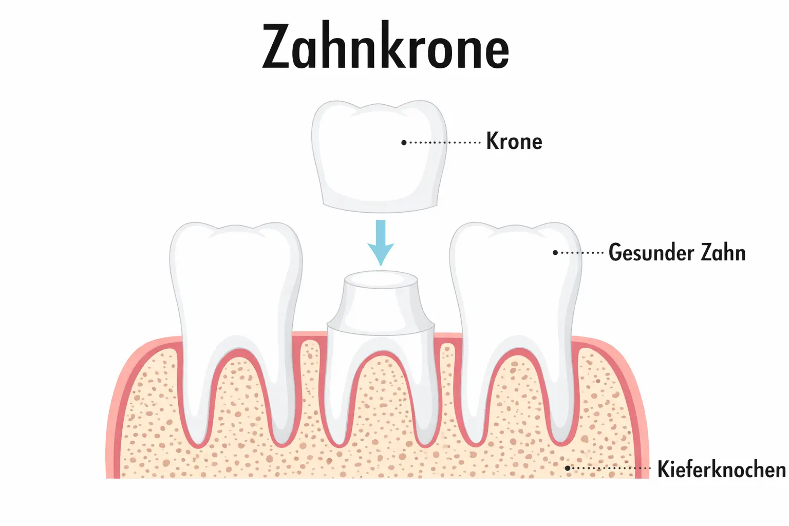Schaubild: Aufbau und Funktion einer Zahnkrone